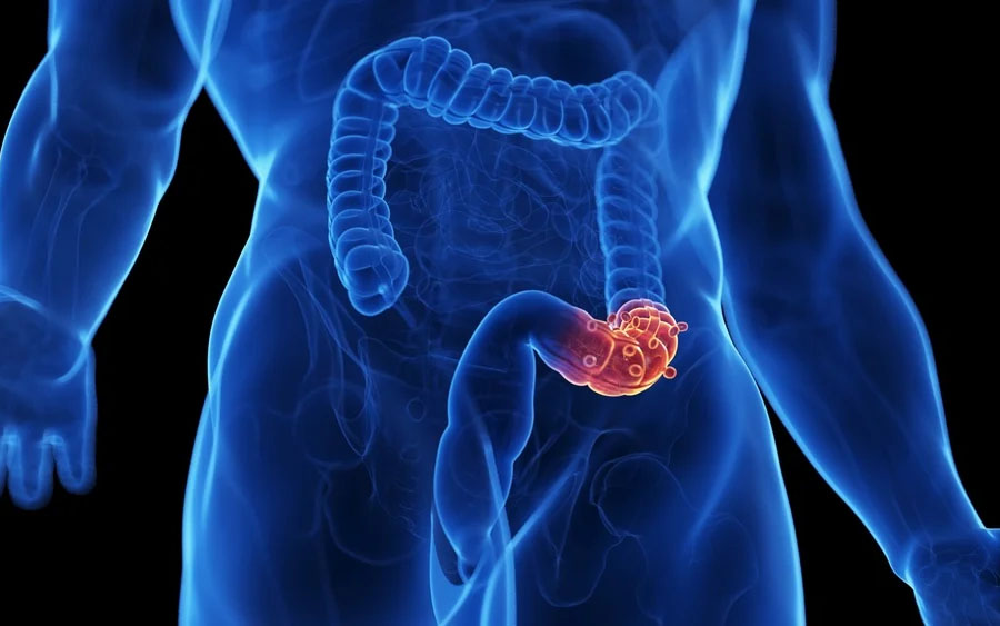 tratamento-diverticulite-belem