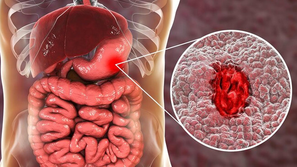 tratamento-ulceras-pepticas-centro-medico-belem